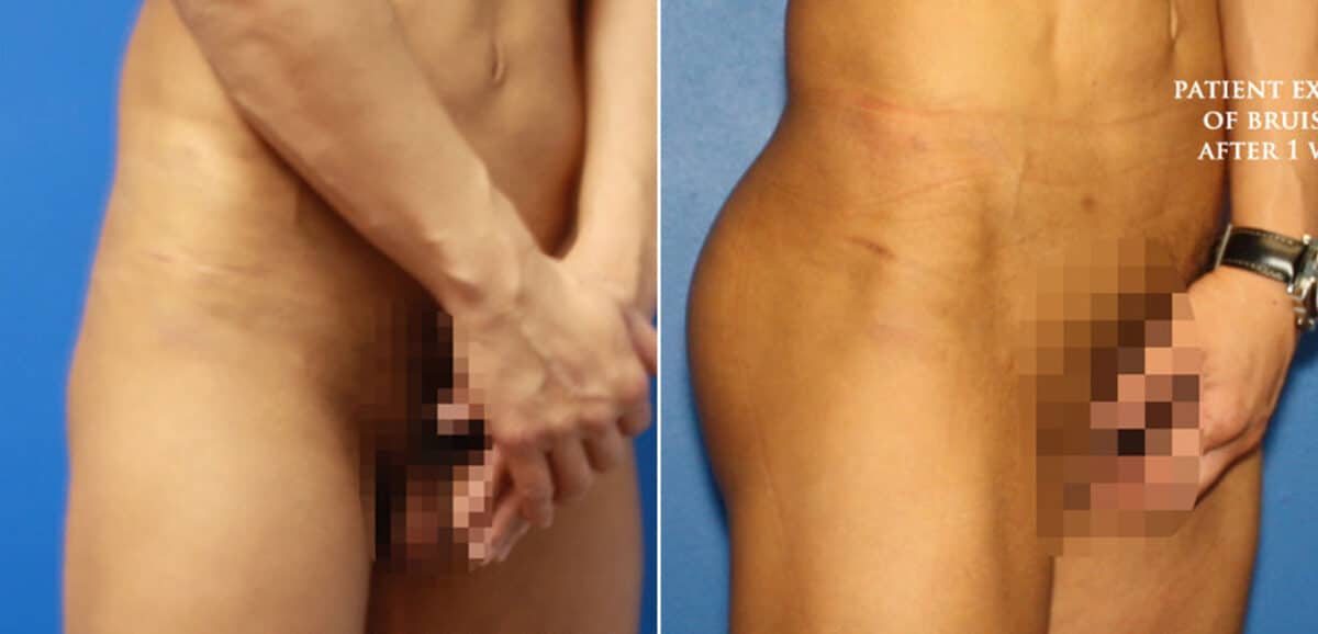 Gluteal Augmentation Before and After Photos in New York, NY, Patient 16648