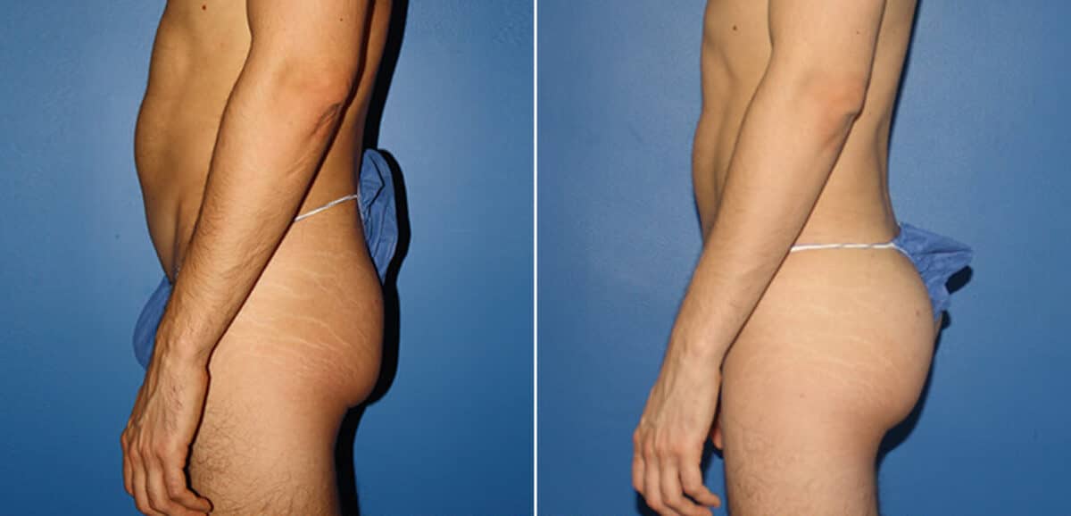 Gluteal Augmentation Before and After Photos in New York, NY, Patient 16670