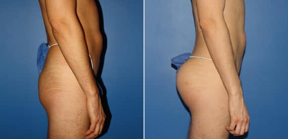 Gluteal Augmentation Before and After Photos in New York, NY, Patient 16670