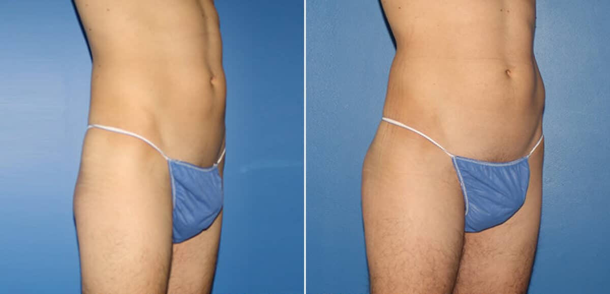 Gluteal Augmentation Before and After Photos in New York, NY, Patient 16670