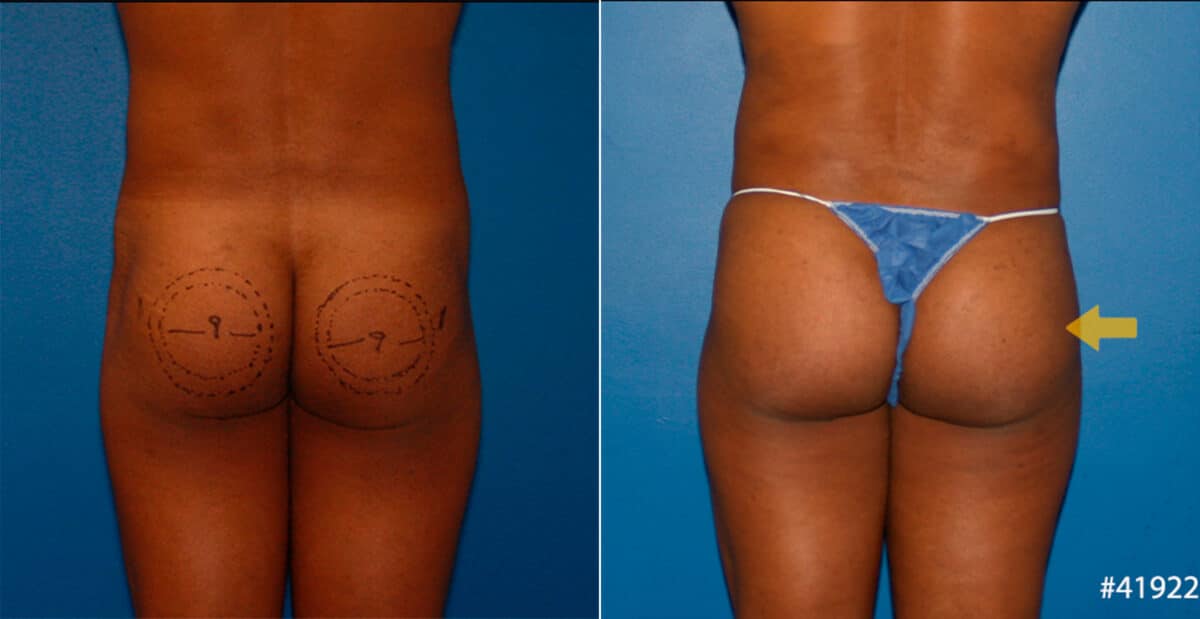 Gluteal Augmentation Before and After Photos in New York, NY, Patient 16712