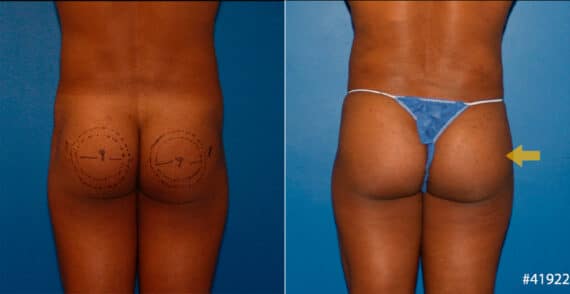 Gluteal Augmentation Before and After Photos in New York, NY, Patient 16712