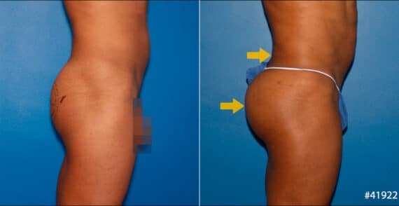 Gluteal Augmentation Before and After Photos in New York, NY, Patient 16712