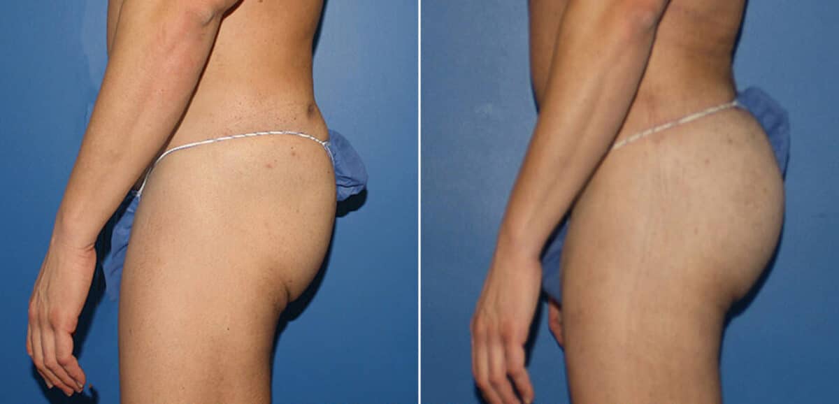 Gluteal Augmentation Before and After Photos in New York, NY, Patient 16480