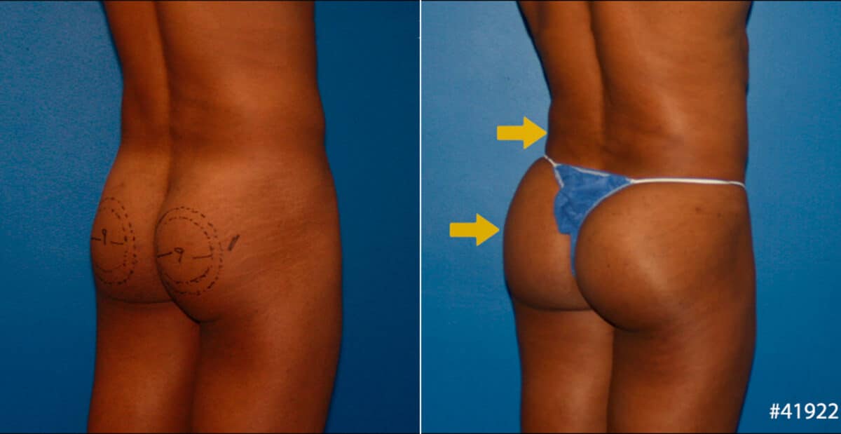 Gluteal Augmentation Before and After Photos in New York, NY, Patient 16712