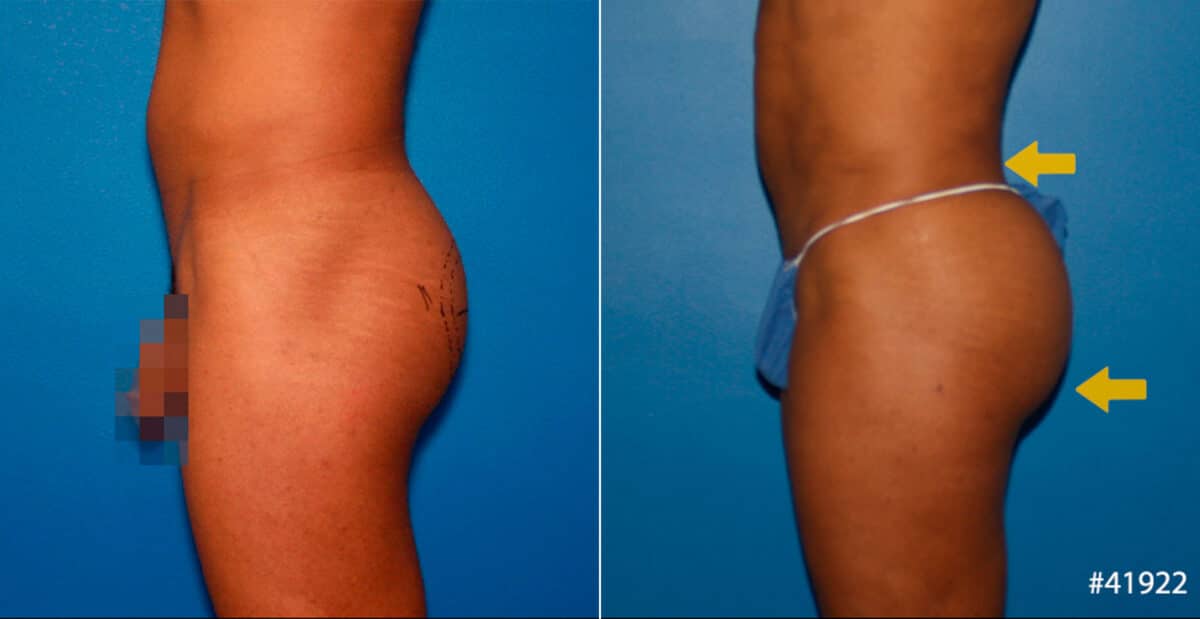 Gluteal Augmentation Before and After Photos in New York, NY, Patient 16712