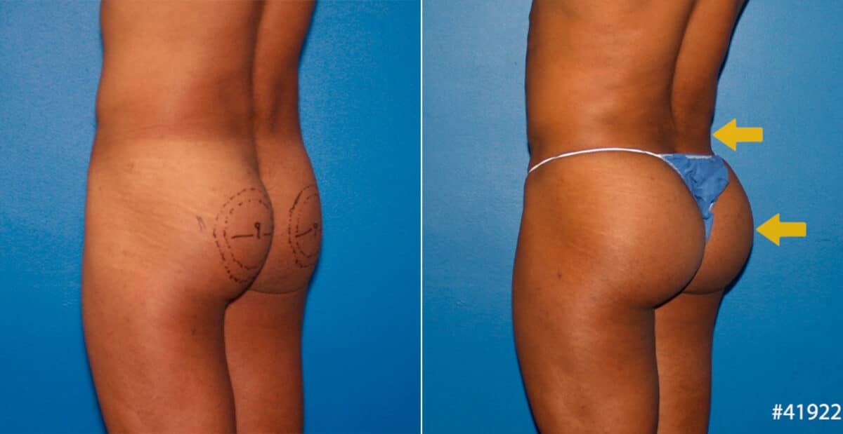 Gluteal Augmentation Before and After Photos in New York, NY, Patient 16712