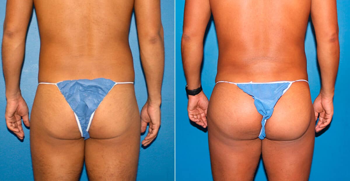 Gluteal Augmentation Before and After Photos in New York, NY, Patient 16754