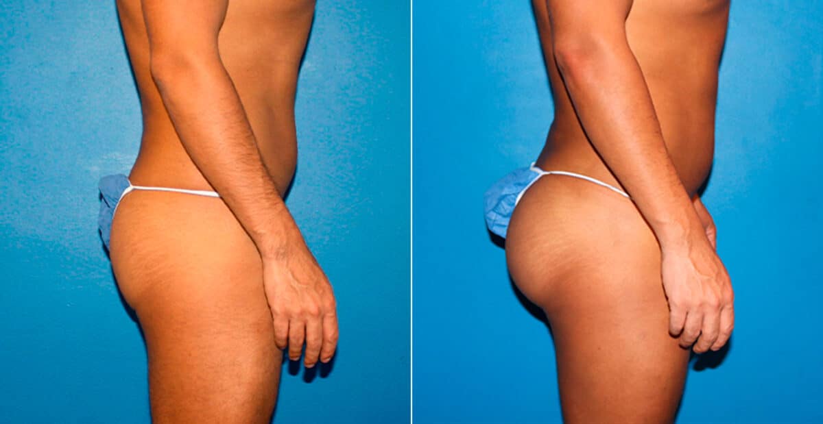 Gluteal Augmentation Before and After Photos in New York, NY, Patient 16754