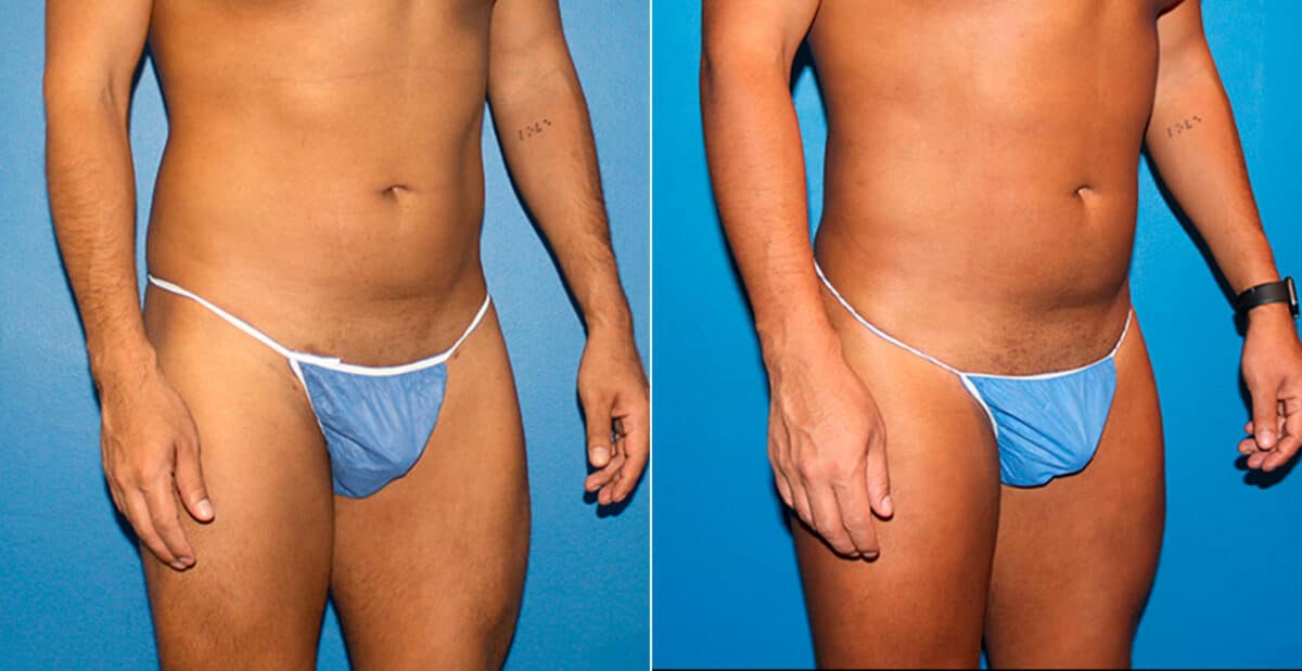 Gluteal Augmentation Before and After Photos in New York, NY, Patient 16754