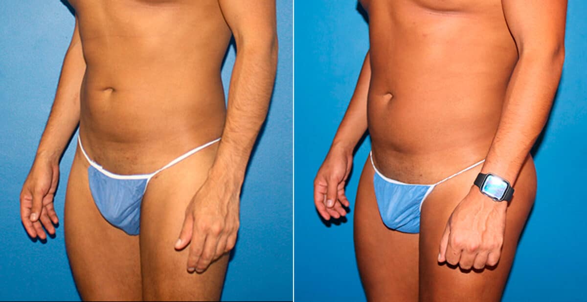 Gluteal Augmentation Before and After Photos in New York, NY, Patient 16754