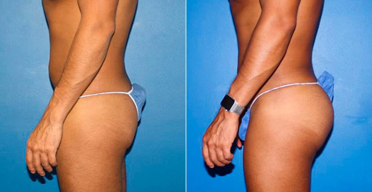 Gluteal Augmentation Before and After Photos in New York, NY, Patient 16754