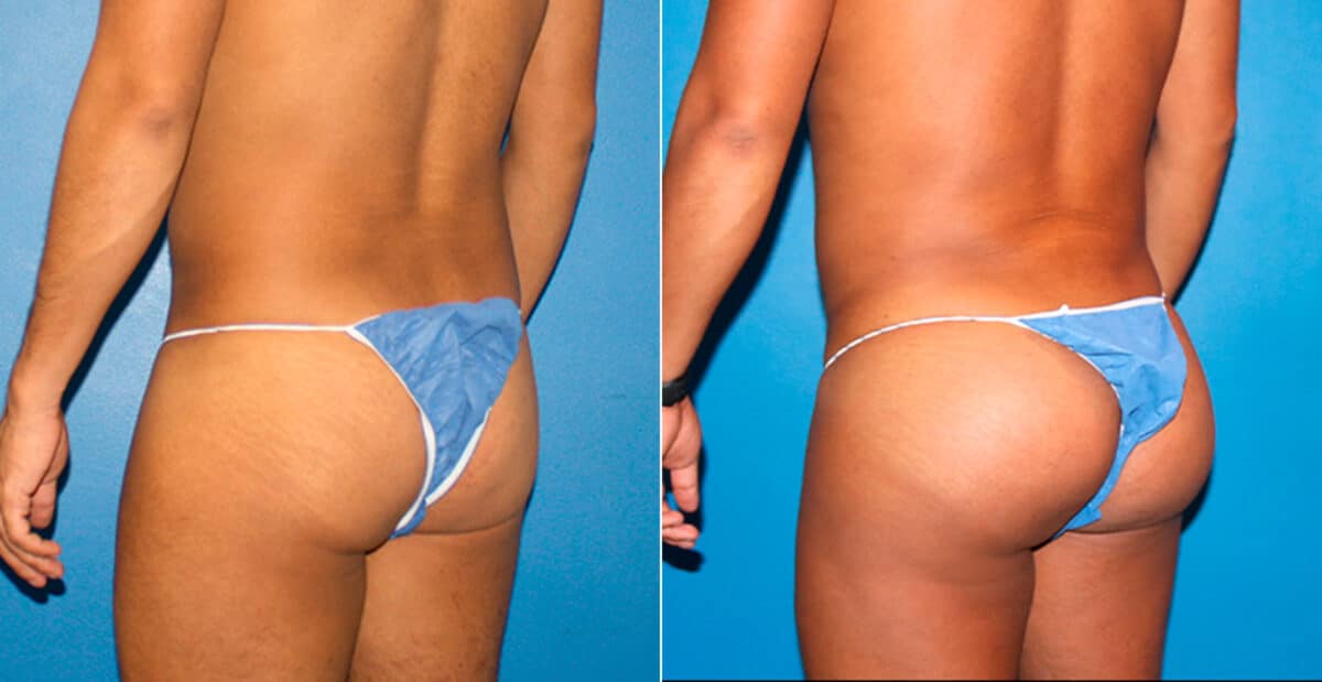 Gluteal Augmentation Before and After Photos in New York, NY, Patient 16754