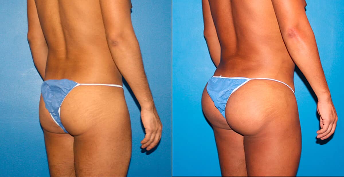 Gluteal Augmentation Before and After Photos in New York, NY, Patient 16754