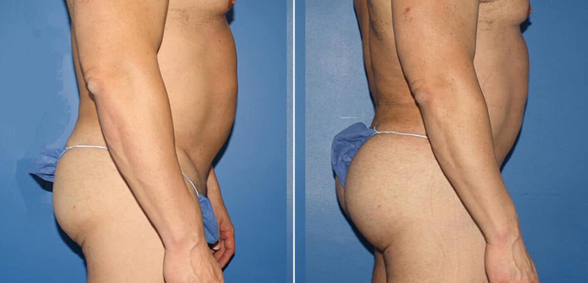 Gluteal Augmentation Before and After Photos in New York, NY, Patient 16480