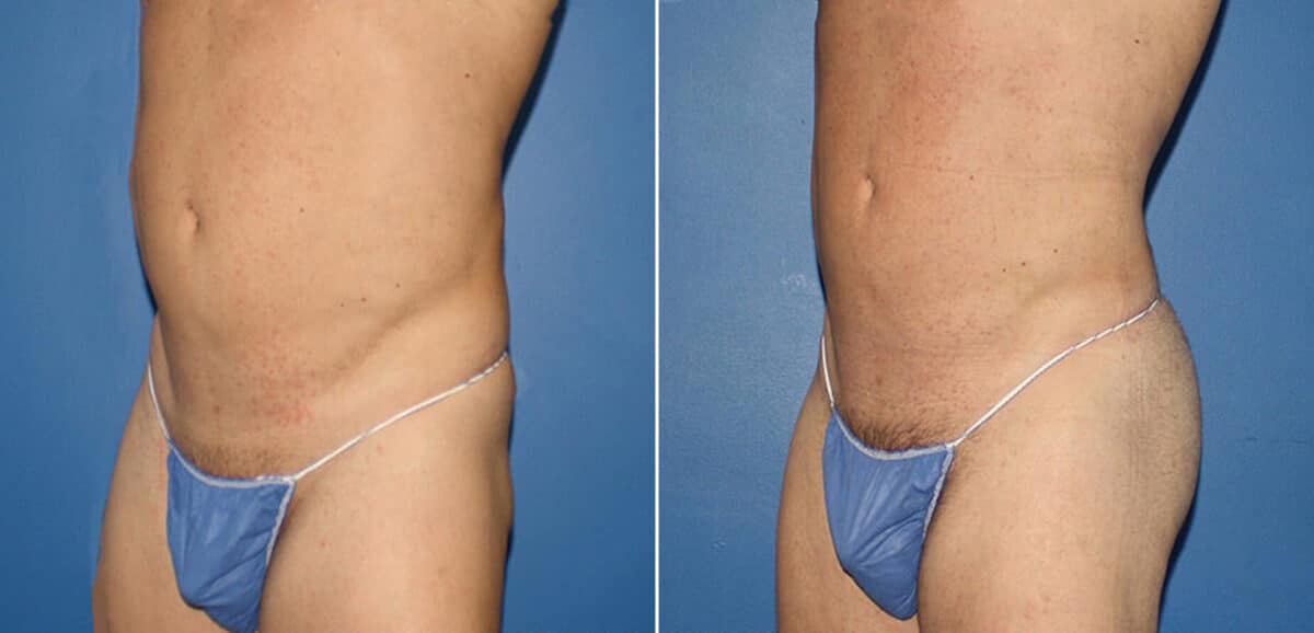 Gluteal Augmentation Before and After Photos in New York, NY, Patient 16480