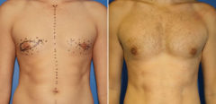 Gynecomastia Before and After Photos in New York, NY, Patient 16239