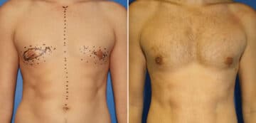 Gynecomastia Before and After Photos in New York, NY, Patient 16239