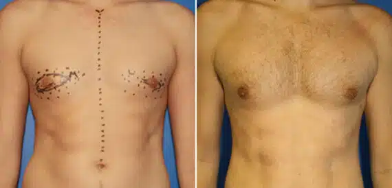 Gynecomastia Before and After Photos in New York, NY, Patient 16239