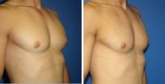 Gynecomastia Before and After Photos in New York, NY, Patient 16235