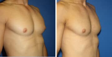 Gynecomastia Before and After Photos in New York, NY, Patient 16235