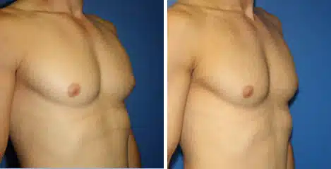 Gynecomastia Before and After Photos in New York, NY, Patient 16235