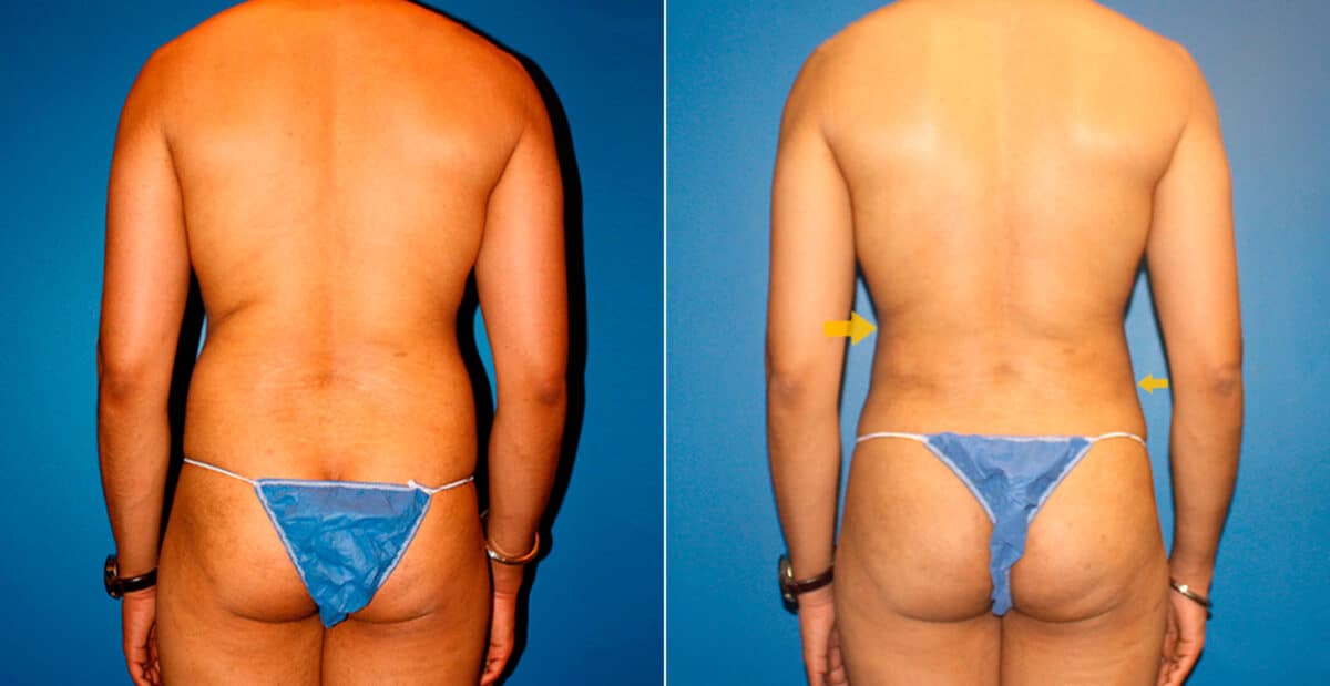 Body Banking Before and After Photos in New York, NY, Patient 16731