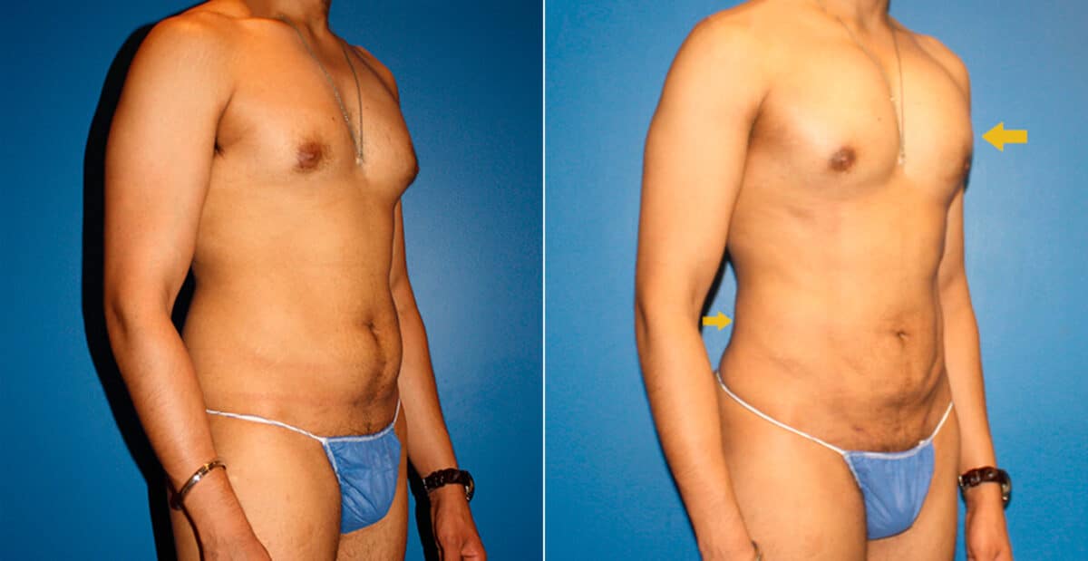 Body Banking Before and After Photos in New York, NY, Patient 16731