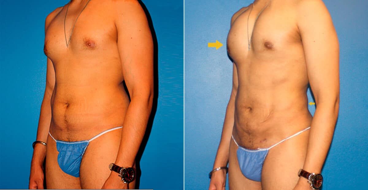 Body Banking Before and After Photos in New York, NY, Patient 16731