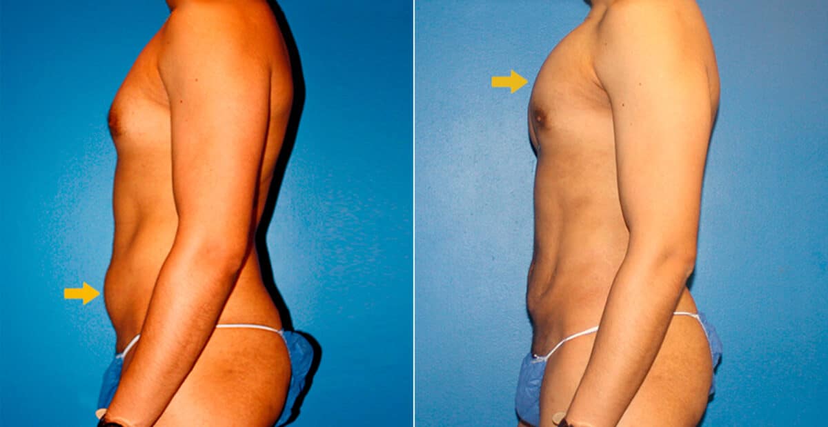 Body Banking Before and After Photos in New York, NY, Patient 16731