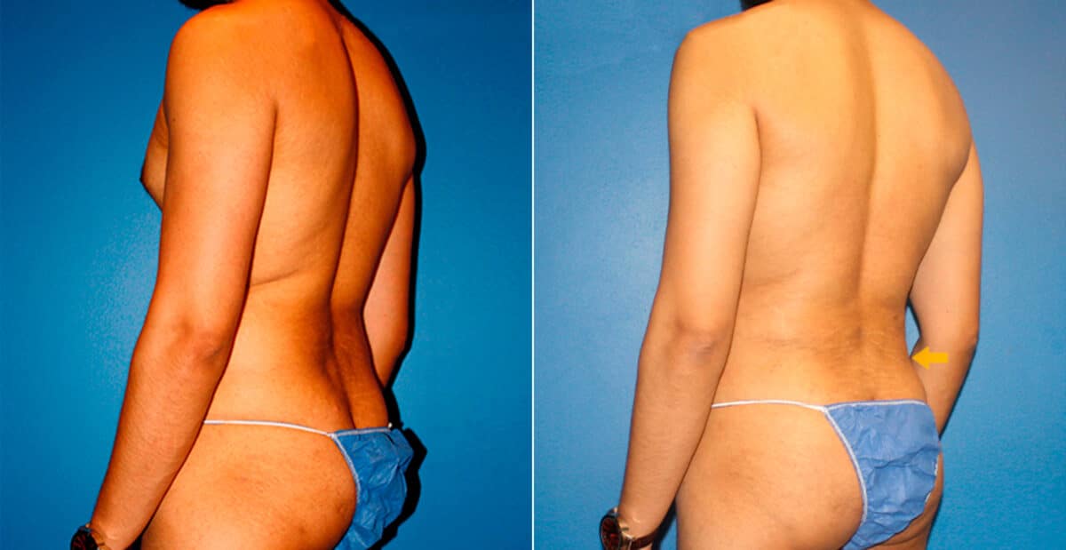 Body Banking Before and After Photos in New York, NY, Patient 16731