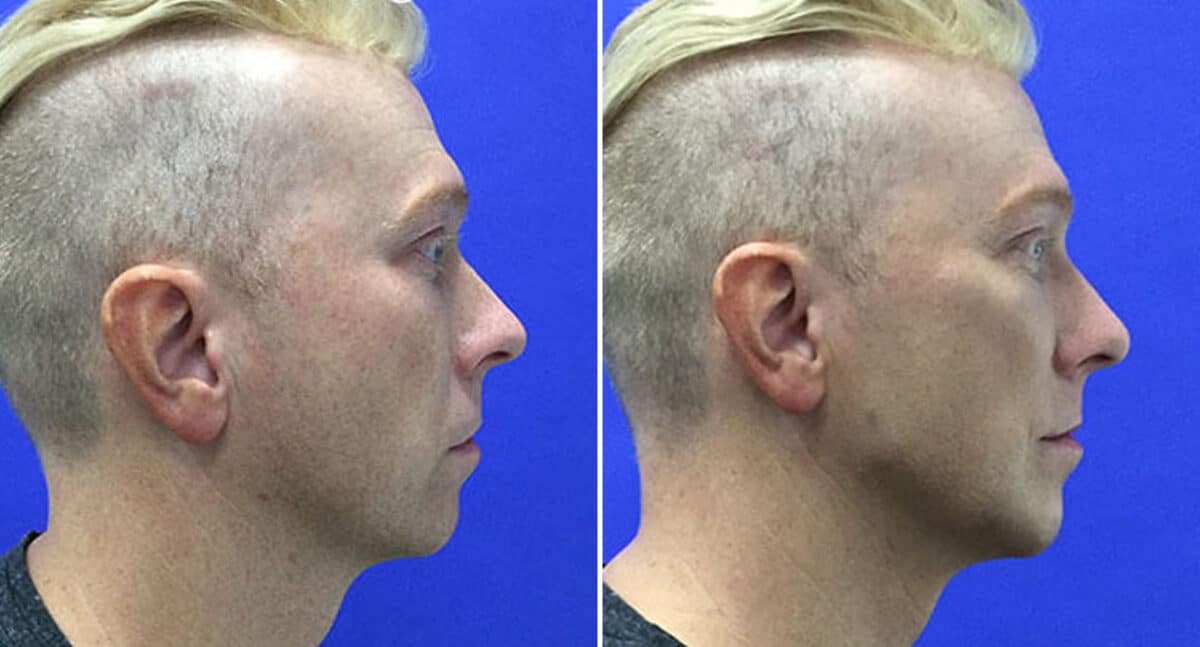 Male Model Make Over Before and After Photos in New York, NY, Patient 16271