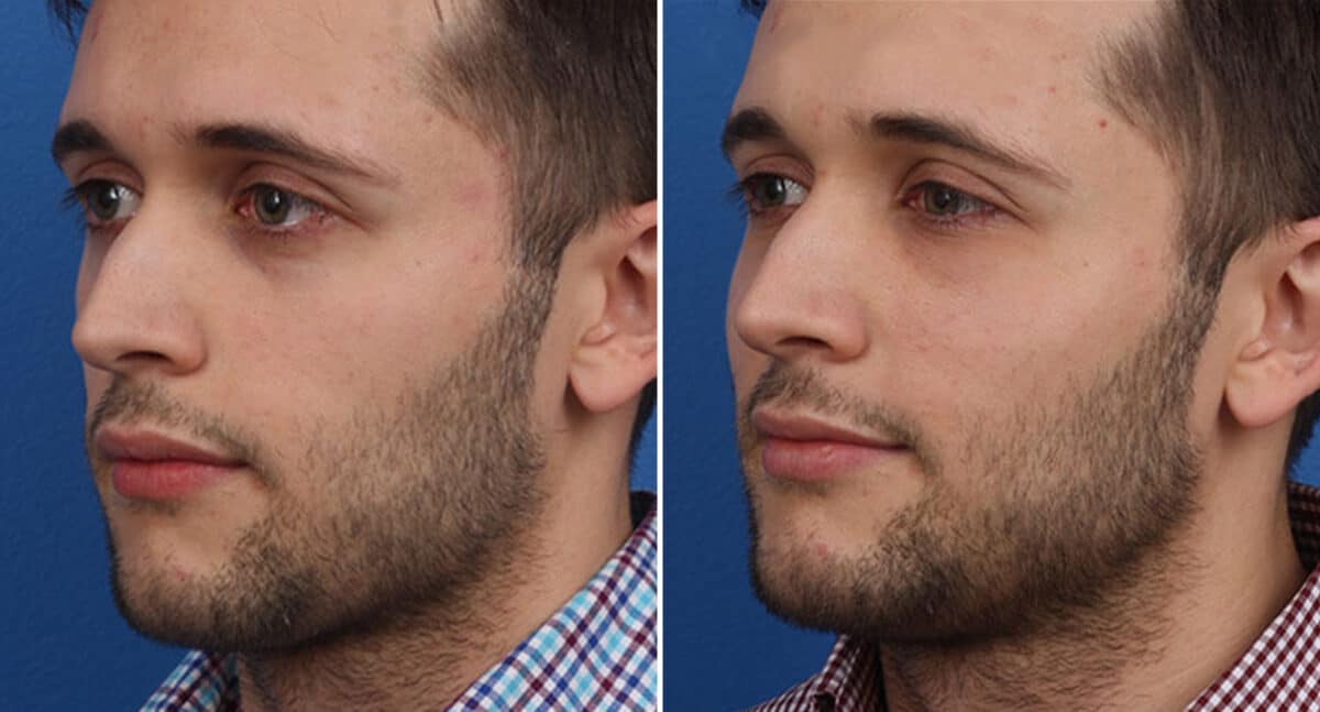 Male Model Make Over Before and After Photos in New York, NY, Patient 16307