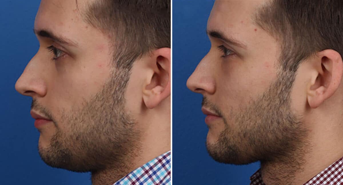 Male Model Make Over Before and After Photos in New York, NY, Patient 16307