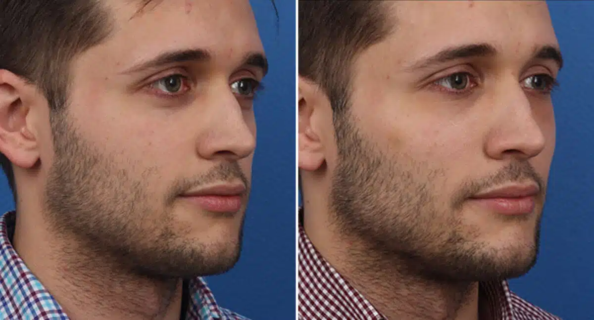 Male Model Make Over Before and After Photos in New York, NY, Patient 16307