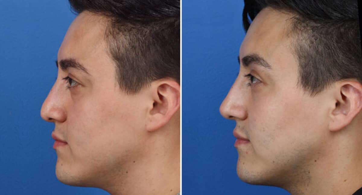 Male Model Make Over Before and After Photos in New York, NY, Patient 16263