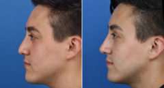 Male Model Make Over Before and After Photos in New York, NY, Patient 16263