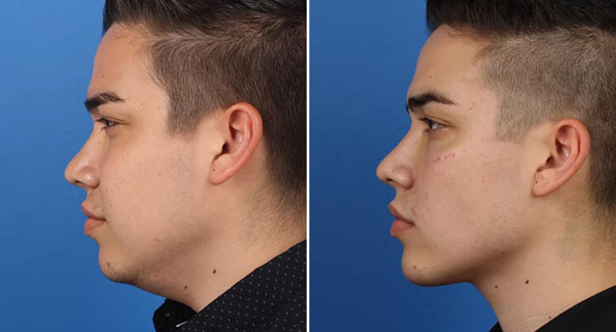 Male Model Make Over Before and After Photos in New York, NY, Patient 16267