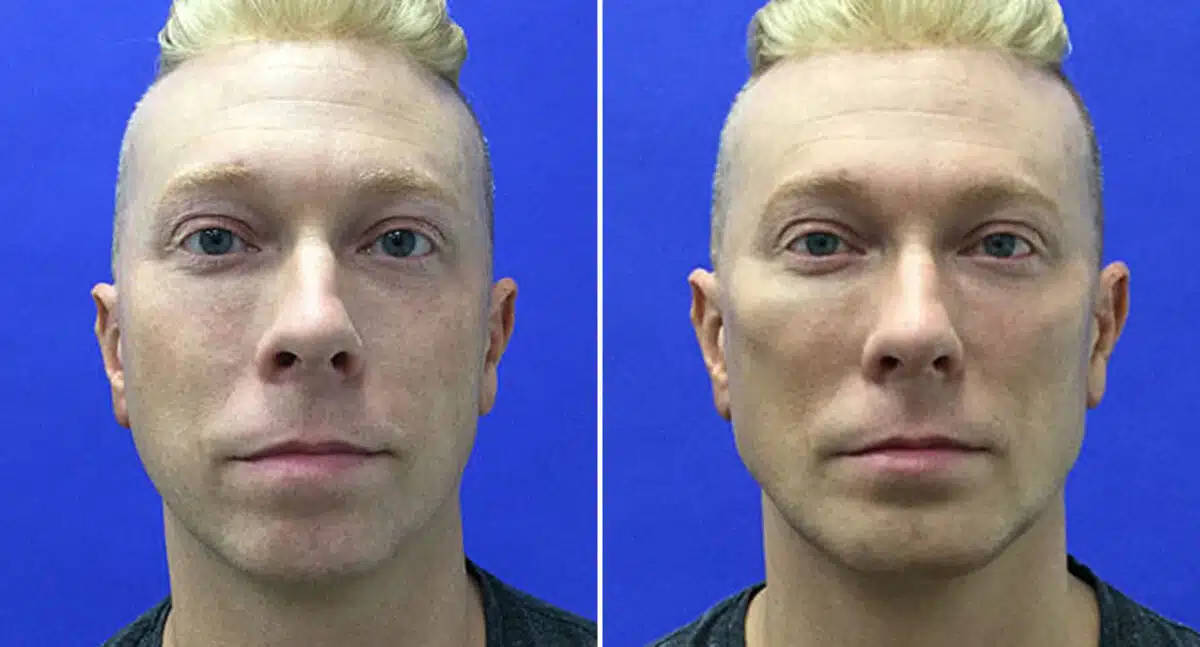 Male Model Make Over Before and After Photos in New York, NY, Patient 16271