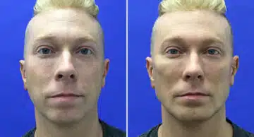 Male Model Make Over Before and After Photos in New York, NY, Patient 16271