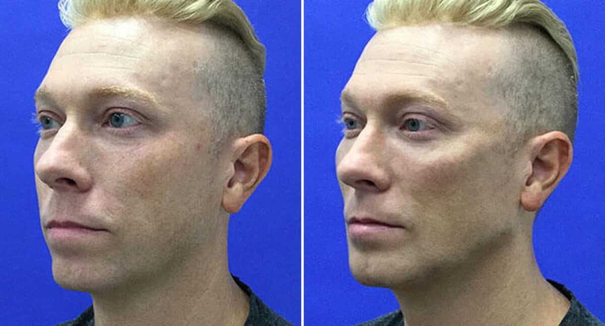 Male Model Make Over Before and After Photos in New York, NY, Patient 16271