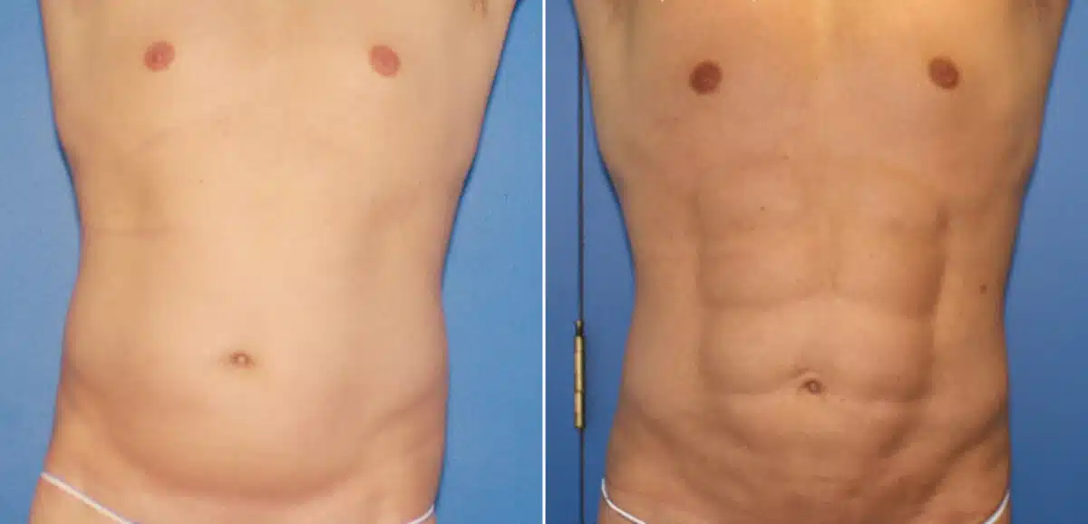 Liposuction Before and After Photos in New York, NY, Patient 16357