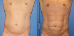 Liposuction Before and After Photos in New York, NY, Patient 16357