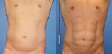Liposuction Before and After Photos in New York, NY, Patient 16357