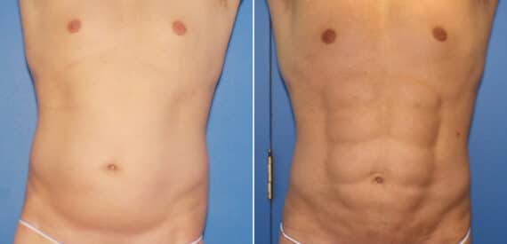 Liposuction Before and After Photos in New York, NY, Patient 16357