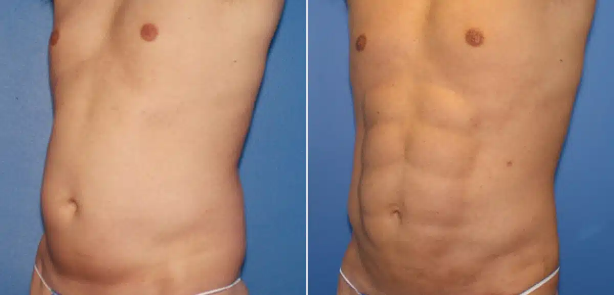 Liposuction Before and After Photos in New York, NY, Patient 16357