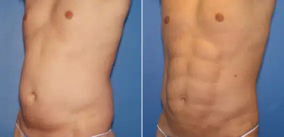 Liposuction Before and After Photos in New York, NY, Patient 16357