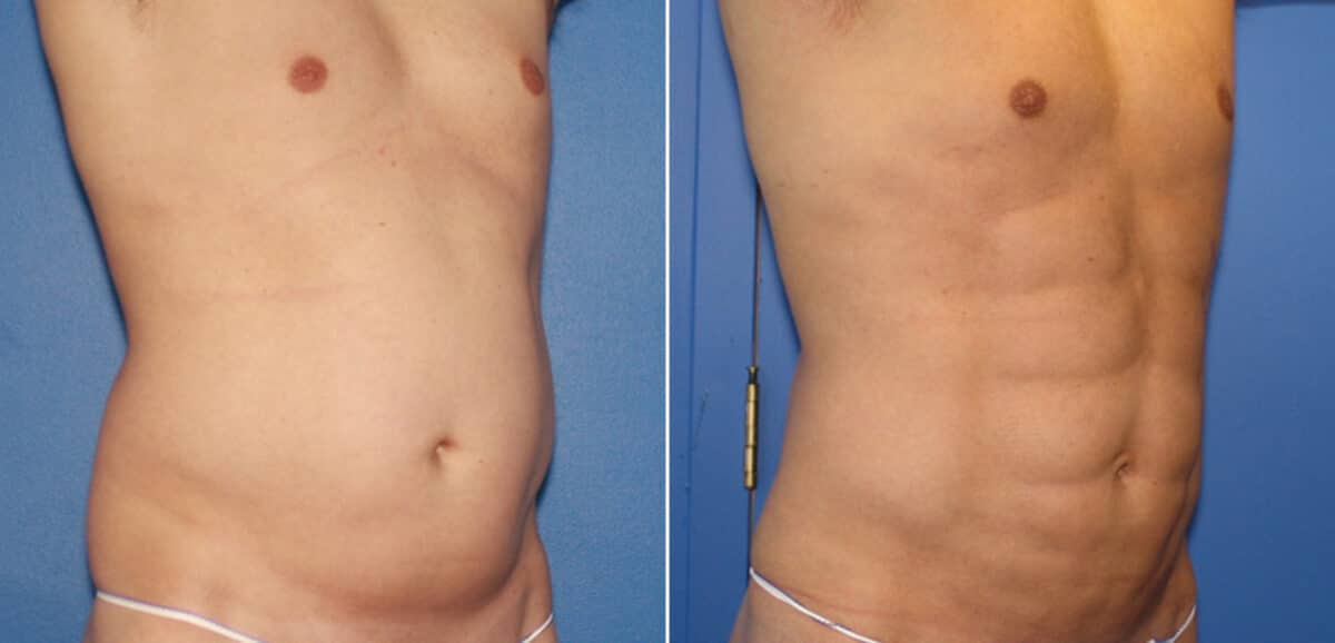 Liposuction Before and After Photos in New York, NY, Patient 16357