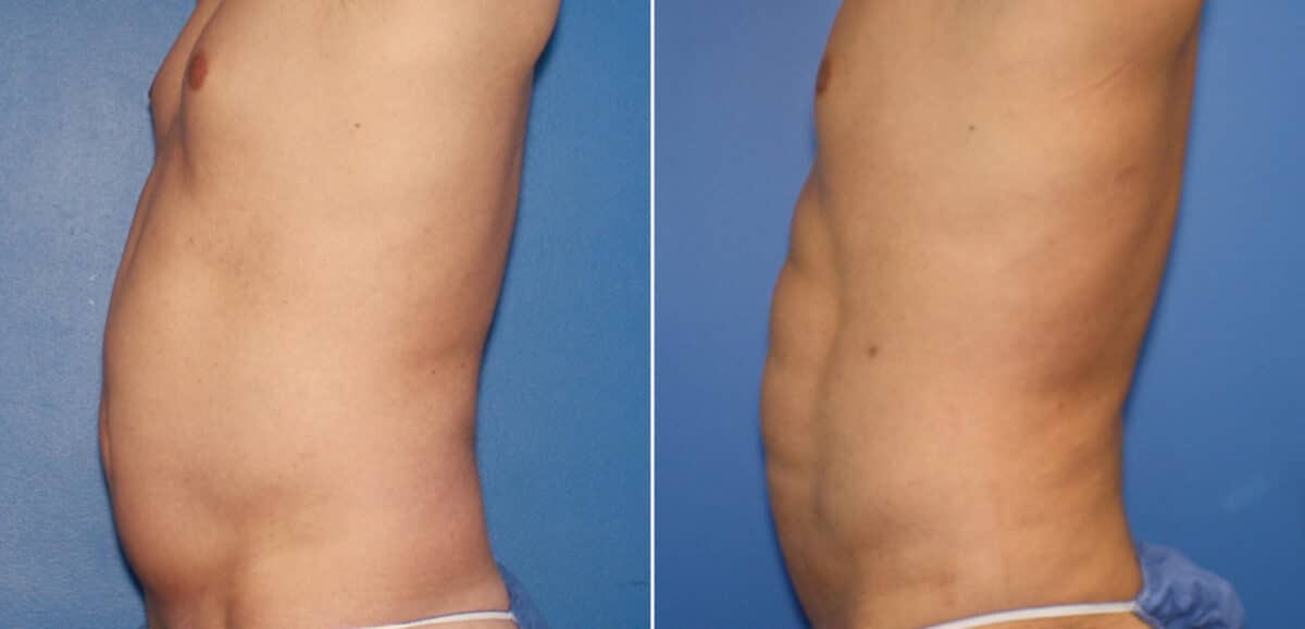 Liposuction Before and After Photos in New York, NY, Patient 16357