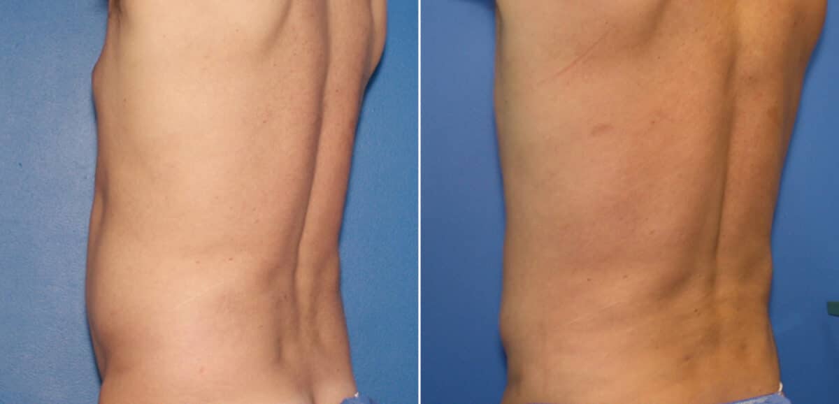 Liposuction Before and After Photos in New York, NY, Patient 16357